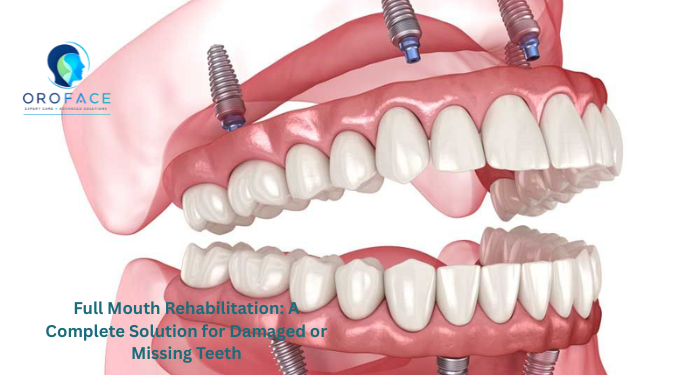 Restore your smile with Full Mouth Rehabilitation by the Best Maxillofacial Surgeon in Pune. Advanced implant, restorative, and aesthetic dental solutions for complete oral rehabilitation.