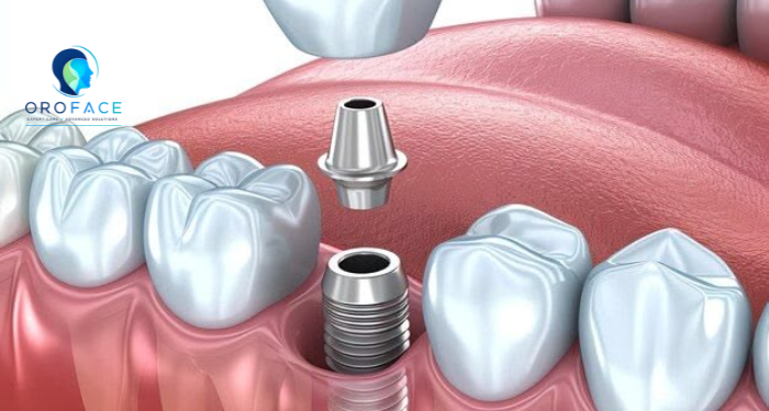 dental implantology, dental implants Pune, Dental Implant Specialist in Pune, dental implant treatment, dental implant procedure, tooth replacement Pune, implant dentistry, single tooth implant, implant-supported dentures, dental implant specialist